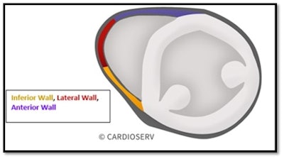Parasternal short-axis (PSAX) view