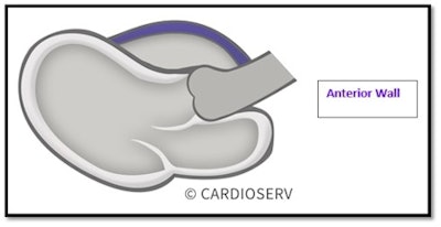 Parasternal long-axis (PLAX) view