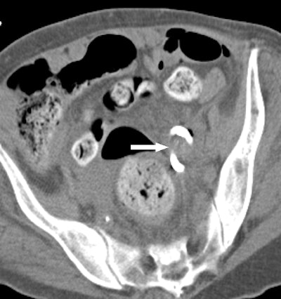 CT image obtained after procedure confirms placement of loop catheter (arrow) and complete drainage of abscess.