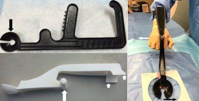 Original F-Spoon (top) with arrow indicating modified keyhole cut into device for needle placement. 3D-printed paddle (below) with arrows showing handgrip and curved armrest that allows ambidextrous use (far right). All images courtesy of AJR.
