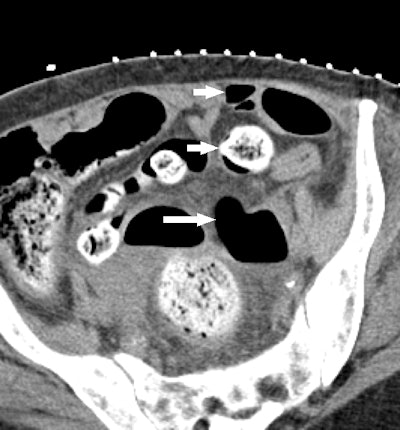 Series of images from an 88-year-old woman with perforated diverticulitis and left pelvic abscess treated with CT-guided percutaneous catheter drainage. CT image above shows pelvic abscess (long white arrow) containing air and fluid. Intervening bowel loops (short white arrows) are present anteriorly, iliac blood vessels laterally, and bone posteriorly. No safe, unobstructed access was available.
