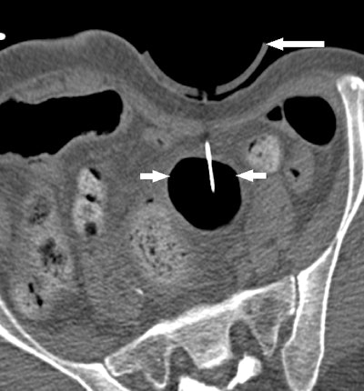 Image obtained during intermittent CT fluoroscopy shows displacement of bowel loops by 3D-printed compression device (long arrow) to give needle and guidewire access to pelvic abscess (short arrows).