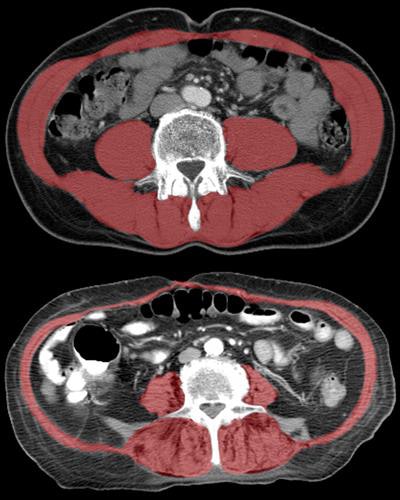 Reduced size and density of core muscle (highlighted in red) as shown in the lower image is associated with frailty and reduced lifespan in hip-fracture patients. Copyright UC Regents 2017.