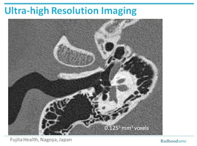 Example from a prototype Toshiba scanner (Aquilion Precision) shows the status of an inner ear at 0.25. Tiny electrodes that could not have been visualized on standard CT are clearly visible. Image courtesy of Dr. Mathias Prokop and Fujita Health, Nagoya, Japan.