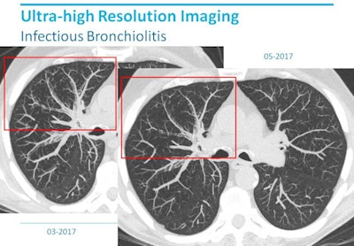 Ultrahigh-resolution lung imaging depicting infectious bronchiolitis on a Toshiba Aquilion Precision scanner shows additional morphologic detail compared with conventional CT. Image courtesy of Dr. Mathias Prokop.
