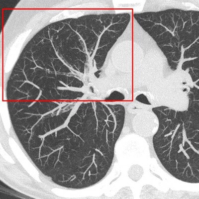 2017 06 06 10 57 35 382 2017 06 06 Bronchiolitis2 Hri Prokop 400