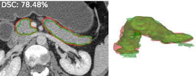 Automated segmentation of the pancreas. Red: manual annotation; green: automated segmentation. Lead developers: Holger Roth, PhD, and Le Lu, PhD.