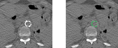 Left, original abdominal CT image. Right, automated segmentation of the calcified aortic plaque. Lead developer in NIH group: Dr. Jiamin Liu.
