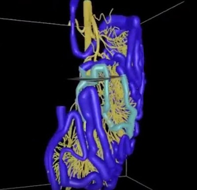 The mesenteric artery can be used to map the small bowel, an intricate organ that presents challenging imaging issues for clinicians looking for lesions, polyps, and tumors. The yellow lines represent vasculature, while the blue lines indicate the small bowel. Image courtesy of Dr. Tan Nguyen and Dr. Ronald Summers, PhD.