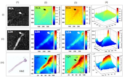 FDG-PET of murine arterial sample shows inflammatory response and macrophage accumulation, an early indication of atherosclerotic plaque. Image courtesy of Stanford University School of Medicine and Stanford University Department of Electrical Engineering.