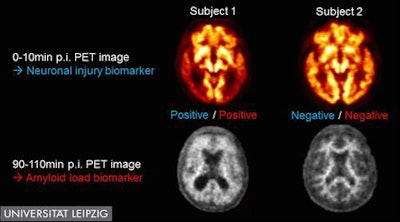 Images of PET with dual-time-point florbetaben radiotracer of two cognitively impaired subjects. While subject No. 1 (left) was judged as positive for both neuronal injury and amyloid load biomarker, both Alzheimer's disease biomarkers were negative in subject No. 2 (right). Image courtesy of Henryk Barthel et al, University Hospital Leipzig, Leipzig, Germany.