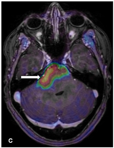 Contrast enhancement from the PET radiotracer FET highlights the brainstem glioma. Image courtesy of Albatly et al and the Journal of Nuclear Medicine.