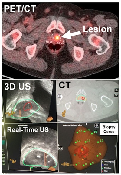 PET/CT (top) shows the lesion in the prostate, followed by CT registered with 3D ultrasound images (middle). Real-time ultrasound images show that the needle during biopsy (bottom left), along with standard 12 cores (cores 4-15) (bottom right), missed the lesion, but PET/ultrasound fusion-targeted biopsy (cores 1-3) detected the prostate cancer. Image courtesy of Baowei Fei, PhD.