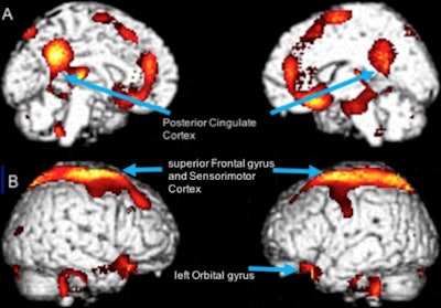SPECT identifies brain regions of significant hyperfusion in former football defensive backs (A) and offensive linemen (B), compared with normal controls (right). Image courtesy of Dr. Dan Silverman, PhD.