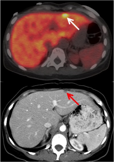 A 49-year-old woman with metastatic pancreatic adenocarcinoma presents with rising CA 19-9 levels. Axial fused PET/CT image with Zr-89 HuMab-5B1 shows focus of uptake in the liver (arrow), correlating with increased liver metastasis seen on diagnostic CT (red arrow) performed two weeks prior. Credit: Christian Lohrmann, Jason Lewis, Wolfgang Weber, Memorial Sloan Kettering Cancer Center; MabVax Therapeutics.