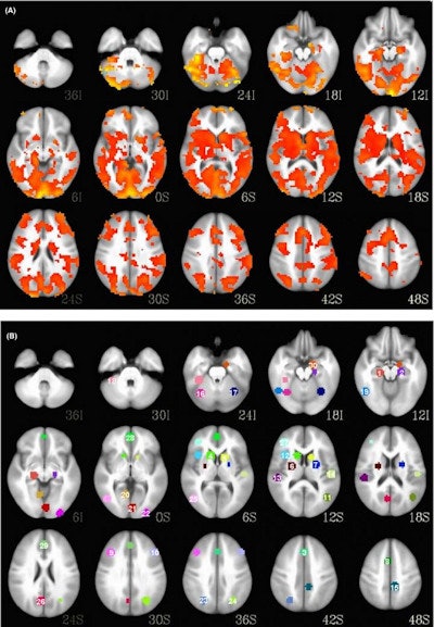 MRI scans of bipolar patient (top) and a healthy patient (bottom). Using functional MRI and proton MR spectroscopy studies, a machine learning-based system can accurately predict how bipolar patients will responds to treatment. Image courtesy of the University of Cincinnati.