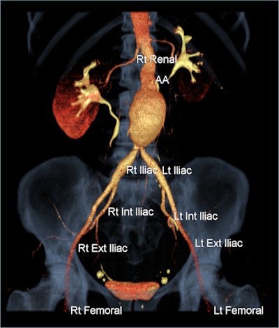The Atlas Maker AI application performs automatic labeling of CT angiography images of the abdominal aorta. All images courtesy of TeraRecon.