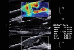 2017 06 18 10 00 02 916 Elastography Lou Jum B 400