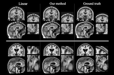 MR images produced by a newly developed method (center column) more closely resemble high-resolution scans (right column). Images courtesy of Golland et al.