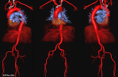 3D color volume-rendered ferumoxytol-enhanced MR angiography images show excellent vascular mapping of the aortoiliofemoral arterial tree in an 87-year-old man with stage 4 renal disease, who is a candidate for transcatheter aortic valve replacement. Image courtesy of Nguyen et al.