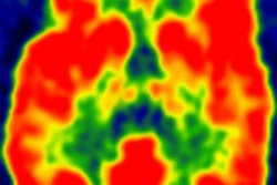 2017 06 23 14 53 10 767 Fdg Pet Alzheimers Uw Madision 20170623215338