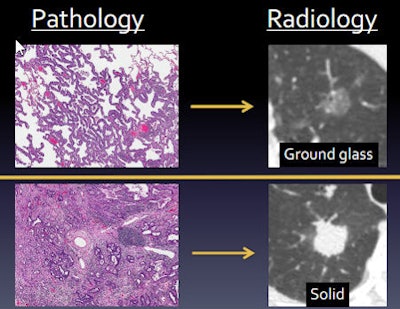 Subsolid nodule pathology (left) versus radiology (right) in CT images of the lung. All images courtesy of Dr. Brett Elicker.