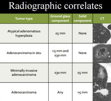 Radiographic correlates for different types of subsolid nodules.