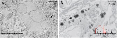 Tissue localization and cellular response to gadolinium deposition are displayed through transmission electron microscopy. Images show cellular localization of gadolinium in dentate nuclei tissue samples from a control patient (A) and from a patient who received gadodiamide (B). X-ray spectra are shown (inset) of each respective panel for selected electron-dense foci (arrows). Gadolinium peaks in spectra are indicated by red overlay. Images courtesy of Radiology.