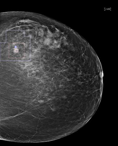 Single mammography view with an automatic overlay indicating a region containing a finding with a high likelihood of malignancy. Image courtesy of Zebra Medical Vision.