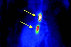 2017 07 07 13 30 25 86 Jnm Blood Clot Image 20170707203054