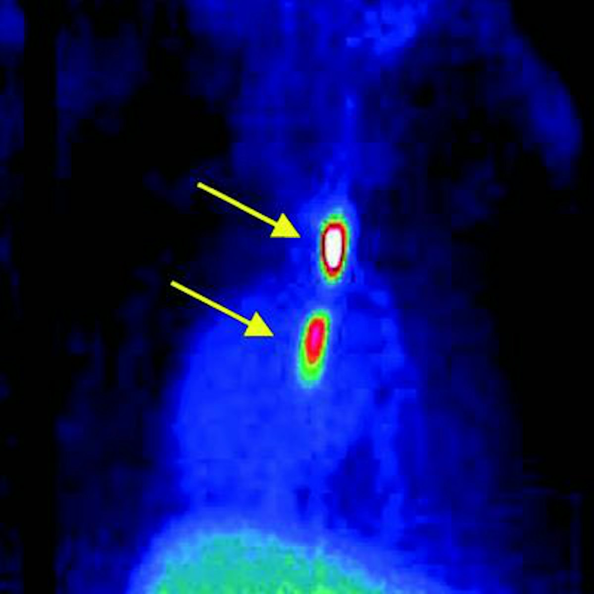 PET agent could advance blood clot imaging | AuntMinnie
