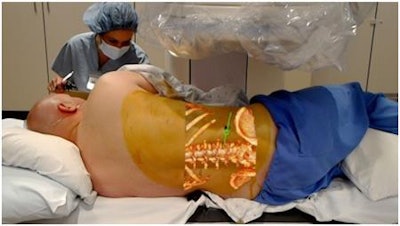 A patient undergoes an automated percutaneous lumbar discectomy while Novarad's OpenSight AR technology assists the operating surgeon, Dr. Wendell Gibby. Image courtesy of Business Wire.