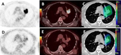 Images from a patient with an upper left lung NSCLC. (A) FDG; (B) FDG-PET/CT; (C) planning radiotherapy based on FDG (66 Gy) with BTVm (gross tumor volume), clinical target volume, and planning target volume; (D) FMISO-PET; (E) FMISO-PET/CT; and (F) boost based on the FMISO-PET (76 Gy) with BTVh (biological hypoxic target volume) and planning target volume boost. Images courtesy of Vera et al and JNM.