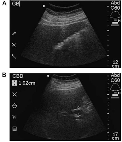Case of cholelithiasis with dilated common bile duct that was correctly diagnosed by all readers on both point-of-care ultrasound and conventional ultrasound. (A, above) Relatively poor-resolution point-of-care ultrasound image demonstrating innumerable dependent gallstones without gallbladder wall thickening. (B, above) Point-of-care image demonstrating a common bile duct dilated to 1.9 cm. (C, below) Higher-resolution conventional image demonstrating cholelithiasis and a dilated common bile duct. All images courtesy of the Journal of Ultrasound in Medicine.