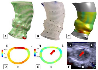 Pre-TAVR CT scans were used to produce the 3D model of the aortic root (A) and the 3D-printed phantom (B). The TAVR prosthesis was deployed in the phantom to simulate the TAVR procedure, from which post-TAVR aortic root strain was quantified in vitro (C, D). The annular bulge index was measured to assess the post-TAVR annular strain unevenness (E), which showed to be predictive of the occurrence, severity, and location of paravalvular leak (F). Image courtesy of Zhen Qian, PhD.