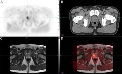 PET/CT image with C-11 sarcosine tracer showed a (triangulated) adenocarcinoma in the transition zone of the anterior right prostate gland on PET (A), CT (B), and a separately obtained T2-weighted MR sequence (C) with resulting PET/MRI registration (D). Image courtesy of Dr. Morand Piert et al, University of Michigan in Ann Arbor, MI.