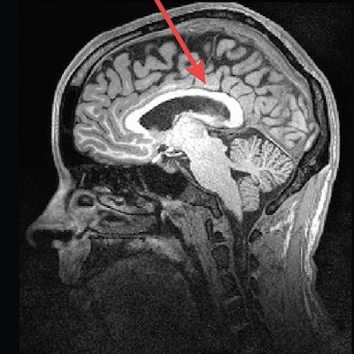 autistic brain vs normal brain