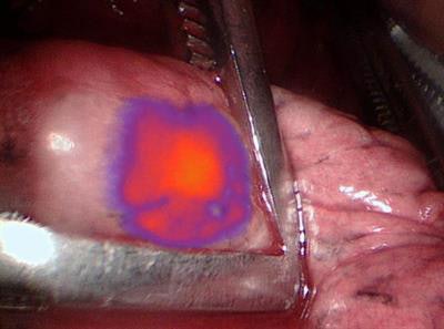 IMI with OTL38 illuminates lung nodules seen on PET/CT to give surgeons a better view. Image courtesy of Dr. Jarrod Predina et al and University of Pennsylvania Perelman School of Medicine.