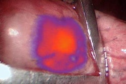 2017 08 09 12 51 54 720 2017 08 10 Imi Otl38 Lung Nodule 20170809195255