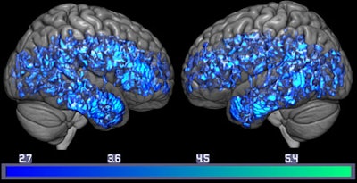 PET brain image shows decrease of serotonin transporters (blue) in the whole mild cognitive impairment group, compared with the whole healthy control group. Image credit: Gwenn Smith lab.