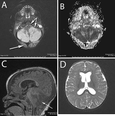 MR images show severe swelling in the cerebellar hemispheres in a 10-month-old baby who accidentally ingested the drug ketamine. Images courtesy of the Journal of Neurosurgery: Pediatrics.