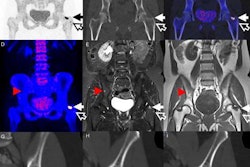 2017 08 17 16 47 15 394 Jnm Bone Mets Lofgren 20170817234758