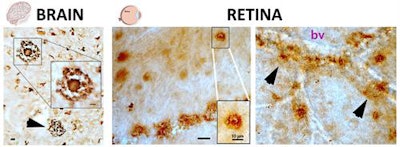 Images show the pathological hallmarks of Alzheimer's disease, beta-amyloid plaques (brown spots), as seen both in brain and retinal tissues from deceased patients. The structures of these plaques in the brain and retina are similar (classical and vascular-associated deposits; bv = blood vessel), suggesting that the retina faithfully represents the brain disease. Adapted from JCI Insight, Koronyo et al.
