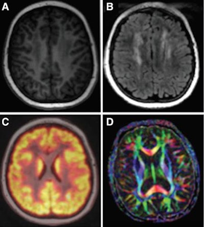 Examples of brain images include axial T1 inversion-recovery spoiled gradient-echo MR image (A); axial T2-FLAIR image (B); fused axial FDG-PET spoiled gradient-echo image (C); and axial diffusion-tensor image (D). Courtesy of Radiology.