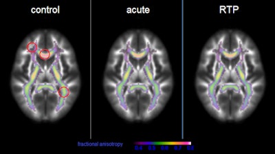 MR images show mean fractional anisotropy in white matter (above) and mean global functional connectivity in gray matter (below) for control subjects compared with concussed athletes after their injury (acute) and when they were clinically cleared to return to play (RTP). Red circles indicate areas of significant concussion effects. Images courtesy of Nathan Churchill, PhD.