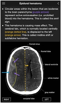 Screenshot of a clinical case (epidural hematoma) included in the app.