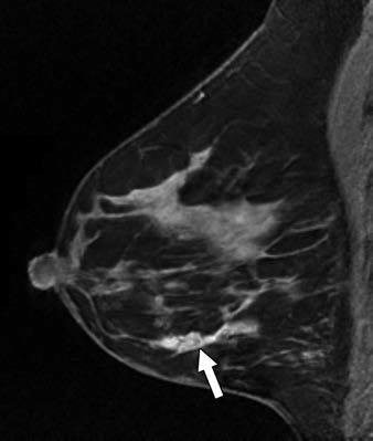 Left breast sagittal contrast-enhanced T1-weighted MR image
