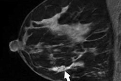 2017 08 29 23 16 5132 Myers Breast Mri B 400