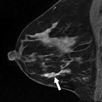 2017 08 29 23 16 5132 Myers Breast Mri B 400