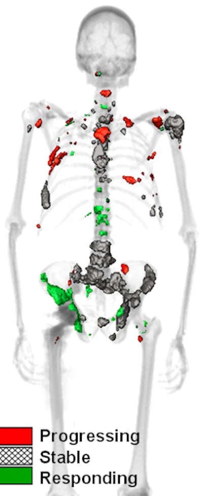 QTBI software identifies lesions that show increasing, decreasing, or stable uptake over the course of treatment. All images courtesy of Timothy Perk.